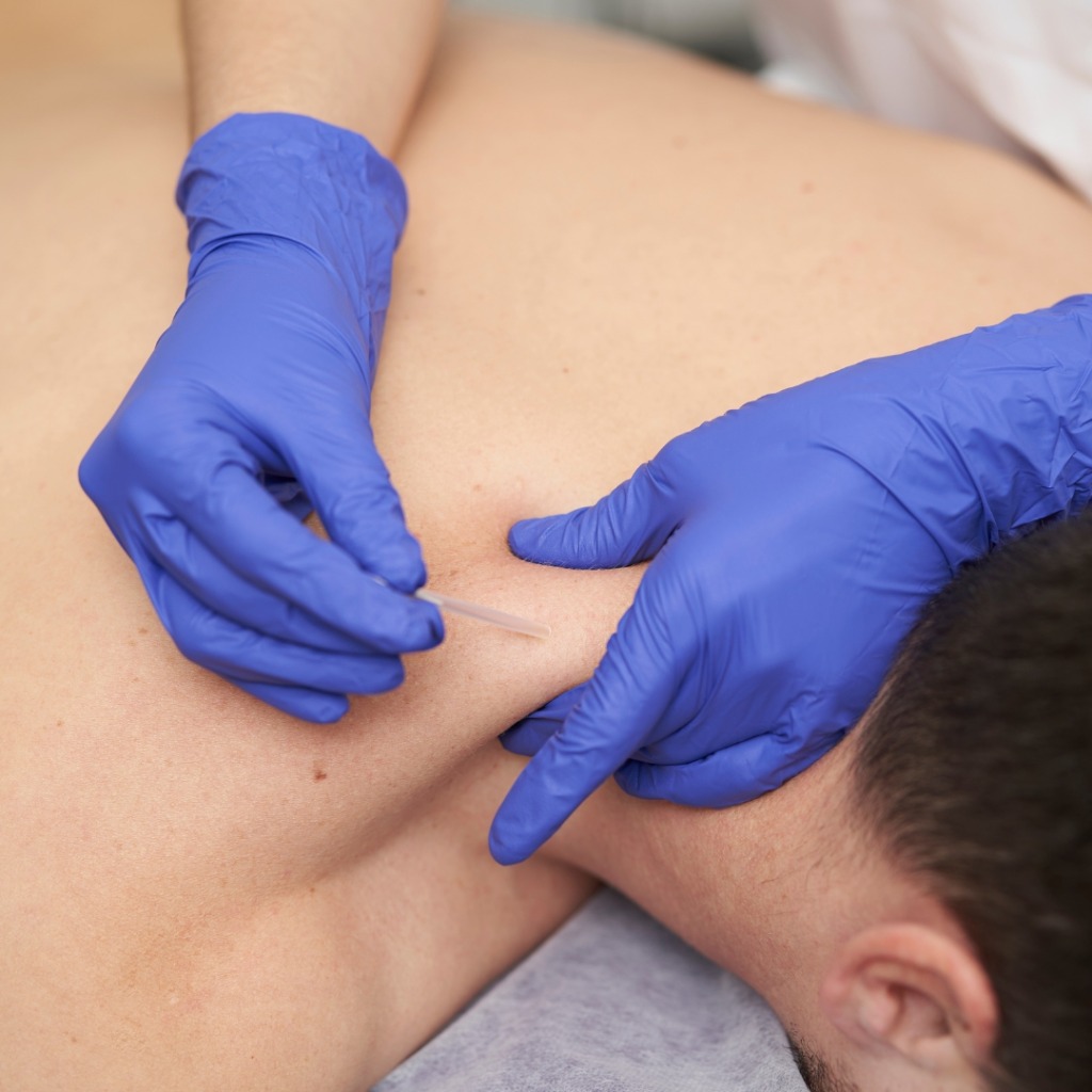 Dry Needling